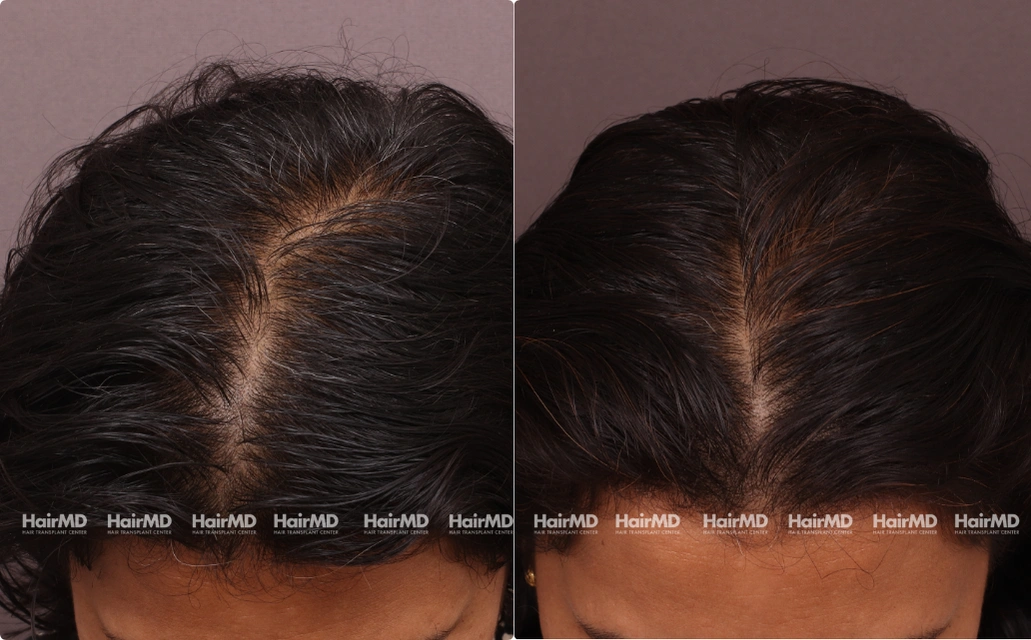 Nutritional Hair Loss Results 7 Sessions 6 Months HairMD Pune 7