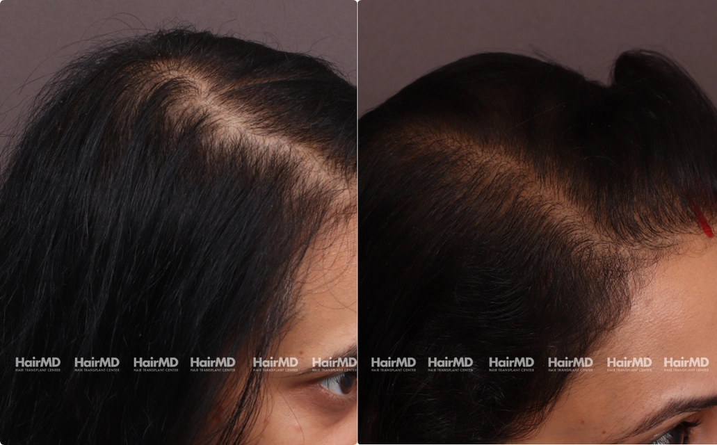 Nutritional Hair Loss Results 7 Sessions 6 Months HairMD Pune