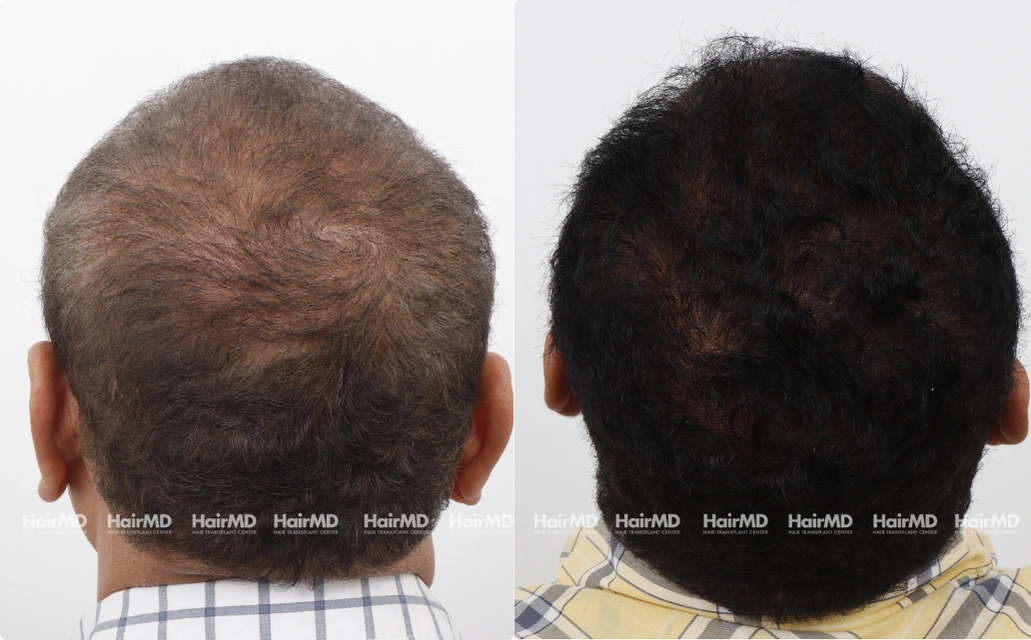 Nutritional Hairloss Results 7 Sessions 6 Months HairMD Pune