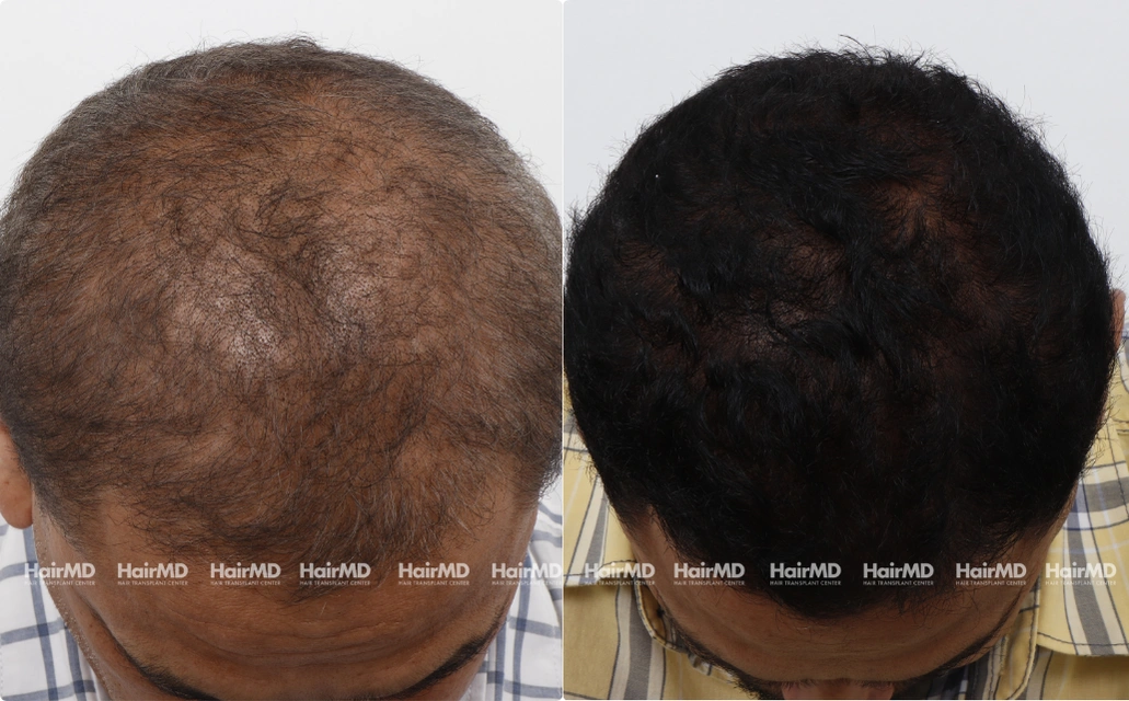 Nutritional Hairloss Results 7 Sessions 6 Months HairMD Pune