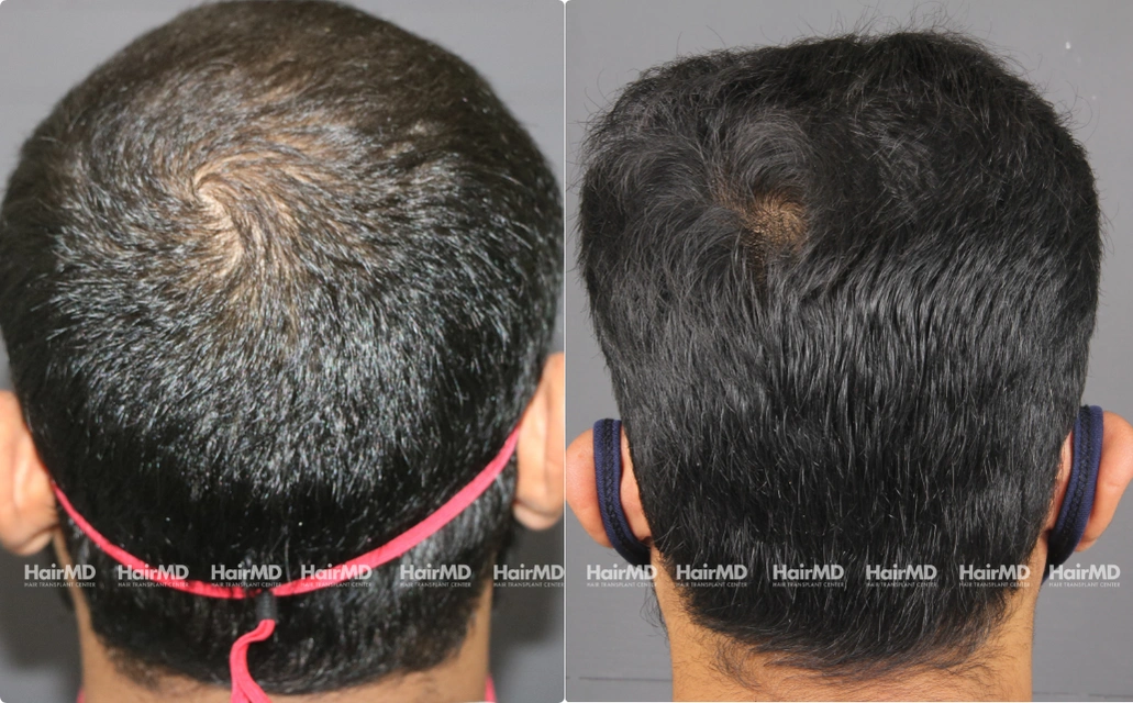 Nutritional Hairloss Results 7 Sessions 6 Months ClearSkin Pune