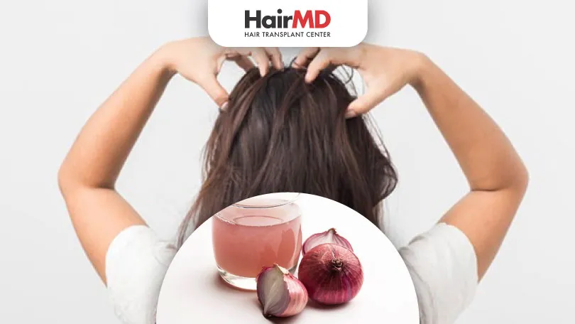 Onion Juice for Hair Growth Does it Actually Work HairMD