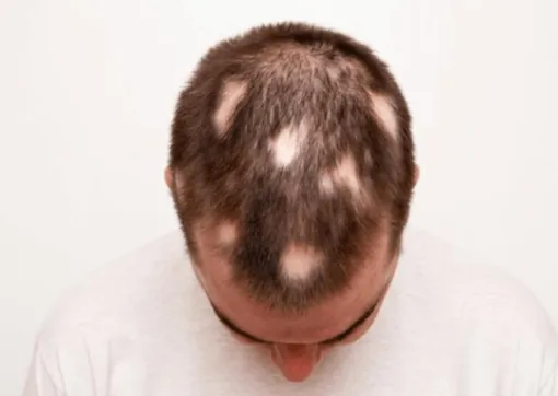 Patchy Hair Loss