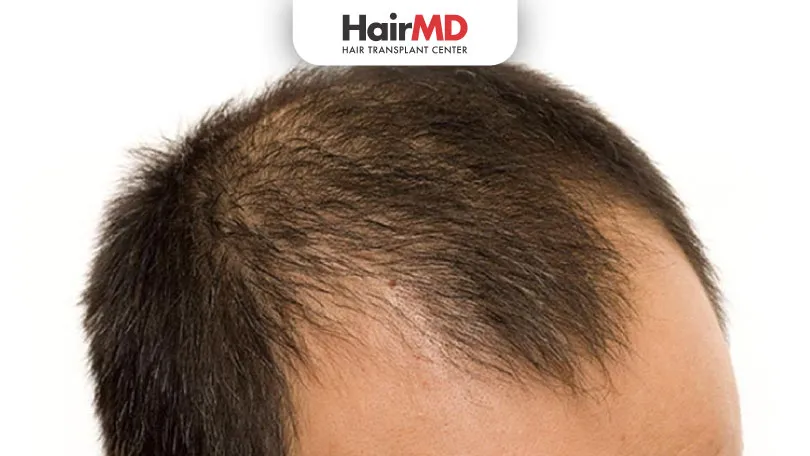 Prevent-Baldness-in-Men-HairMD-Pune