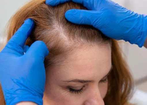 Proven Track Record in Female Hair Regrowth