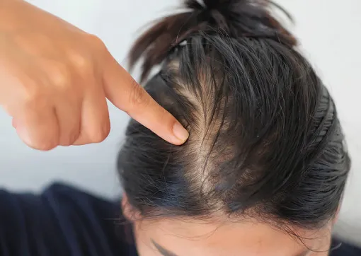 Receding or Thinning Hairline