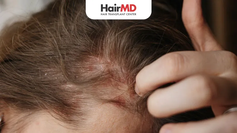 Scalp Eczema vs Psoriasis: Key Differences & Treatments Explained