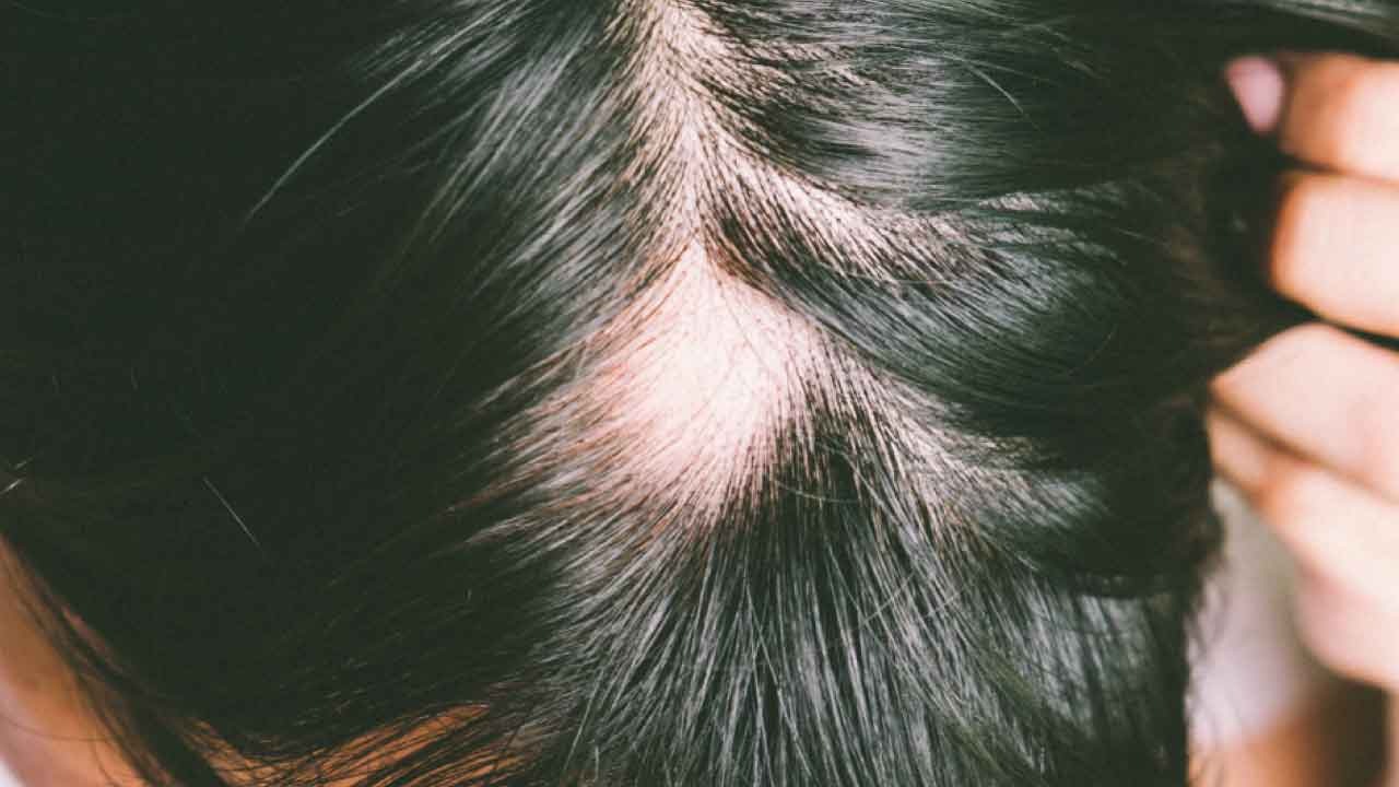 Scarring Alopecia