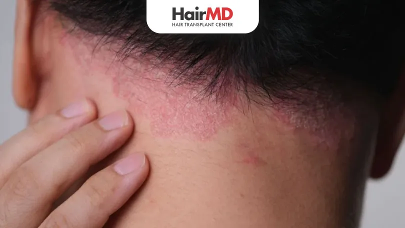 Seborrheic Dermatitis & Hair Loss: Understanding the Connection