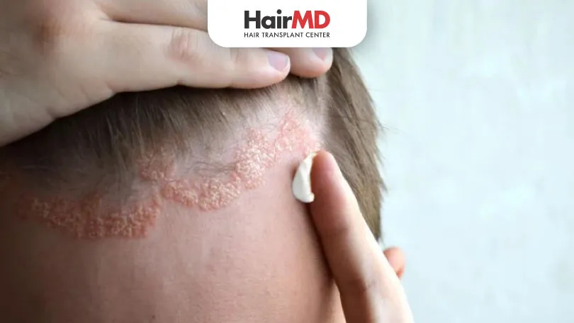 What Does Scalp Dermatitis Look Like
