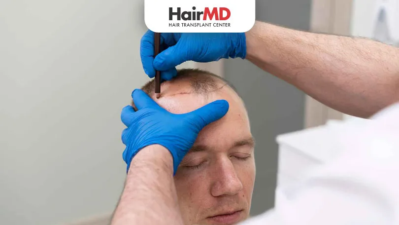 Shock-loss-vs-Shedding-after-hair-Transplant-–-What-does-it-mean-HairMD-Pune