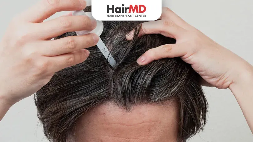 Should You Use Minoxidil for Hair Loss?