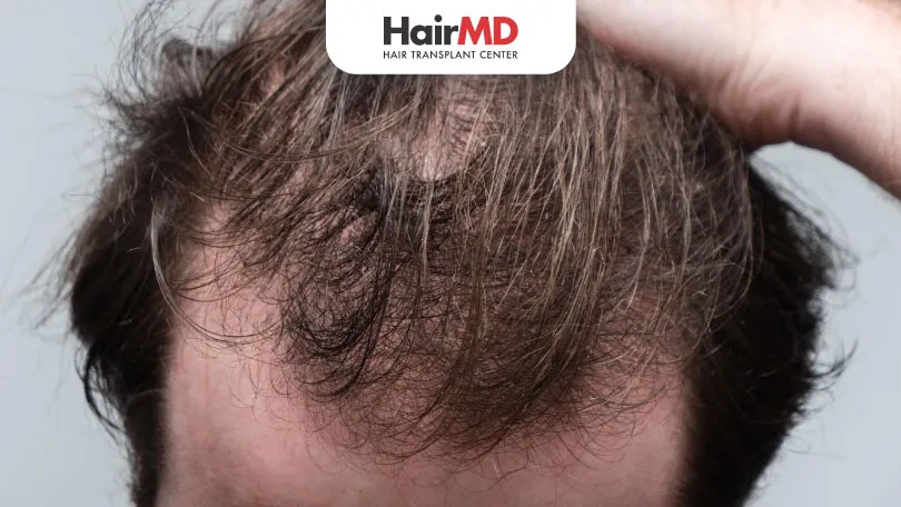 Telogen Effluvium Explained: What Causes This Hair Loss?