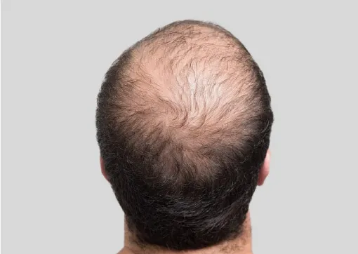 Thinning Hair