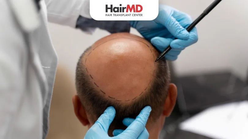 Discover the Top Benefits of Hair Transplant Surgery in India