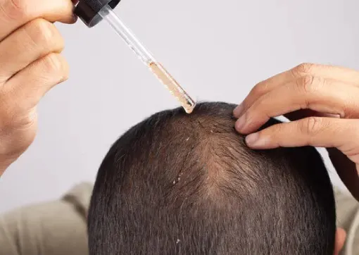 Topical/Oral Medications for Male Hair Loss