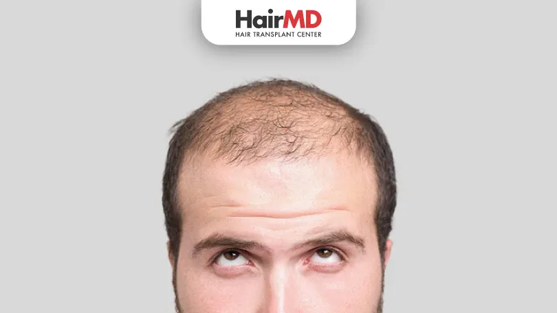 Understanding-Frontal-Baldness-HairMD-Pune