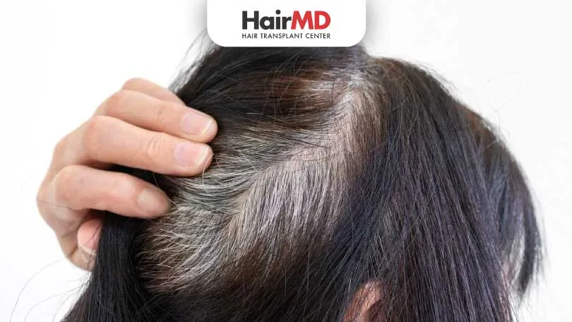 What-are-the-causes-of-premature-greying-of-hair-HairMD-Pune