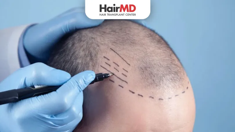 What-is-FUE-Hair-Transplant-Procedure-HairMD-Pune