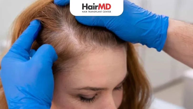 What is Lupus Hair Loss: Connection with Hair Loss