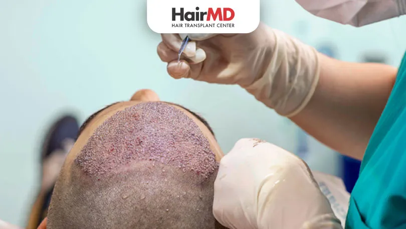 What-is-a-hair-transplant-HairMD-Pune