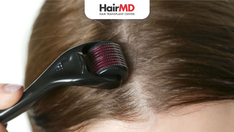 What is the Right Way to Use Dermaroller for Hair Loss?