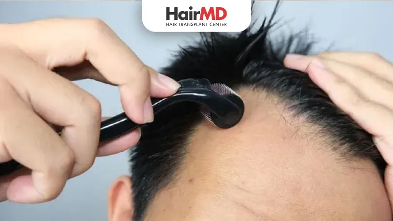 When to Apply Minoxidil After Dermaroller | HairMD