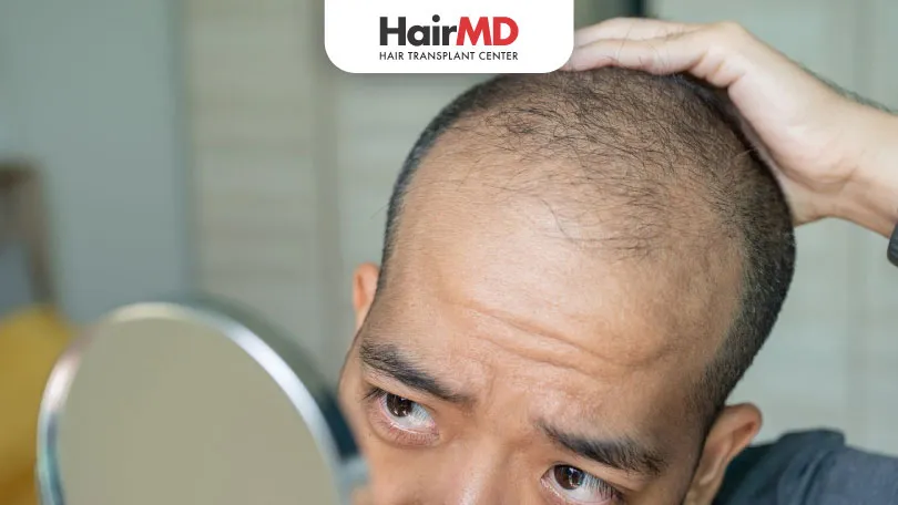 Which-nutritional-Causes-of-Hair-Loss-in-Men-HairMD-Pune