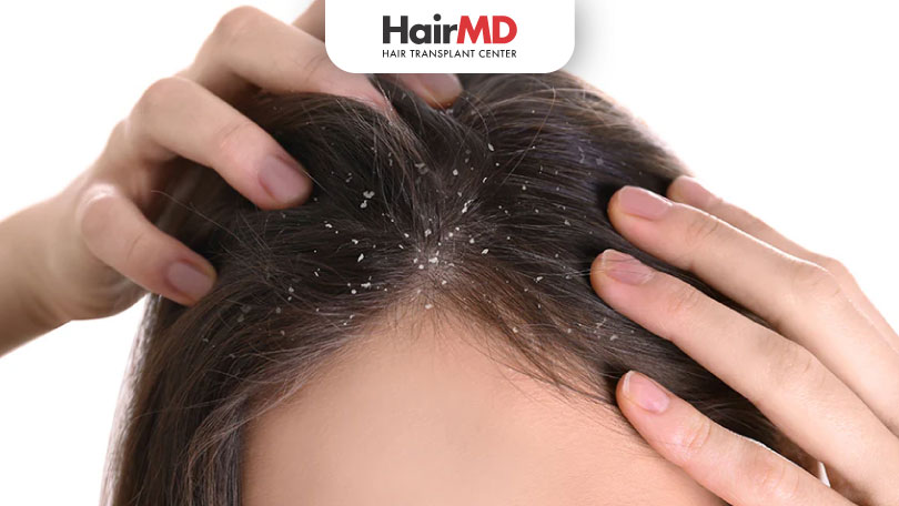 Effective Remedies and Treatments for Winter Dandruff