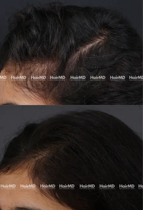 28yrs Female Hairloss Results 6 Months Timeline 7 Sessions HairMD Pune