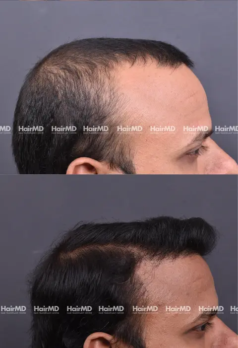 38yrs Male Hairtransplant 2 Years 4000-5000 Grafts HairMD Pune