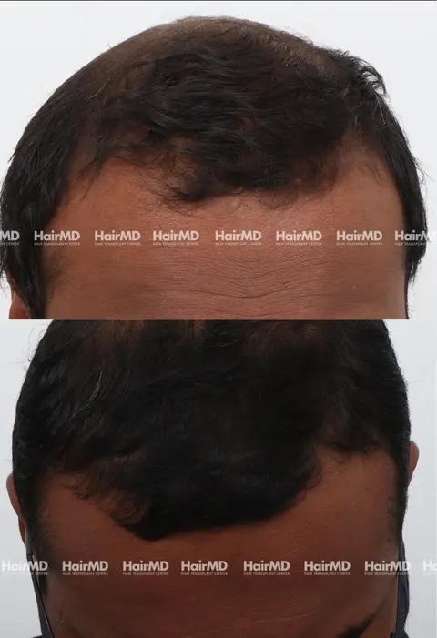 40yrs Baldness Hairloss Results 6 Months Timeline 6 Sessions HairMD Pune