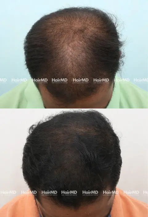 47yrs Baldness Hairloss Results 6 Months Timeline 6 Sessions HairMD Pune