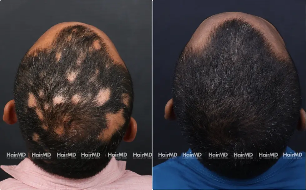 Alopecia areata Results 7 Sessions 6 Months HairMD Pune