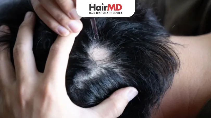 Best Treatment for Alopecia Areata HairMD Pune