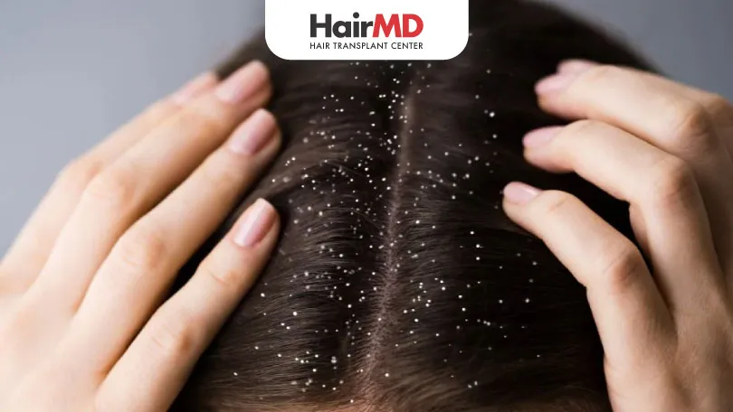 Can Dandruff Cause Hair Fall?