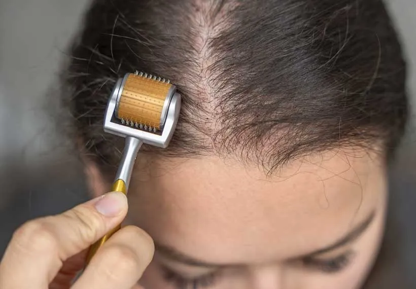 Dermaroller Treatment for Hair Loss