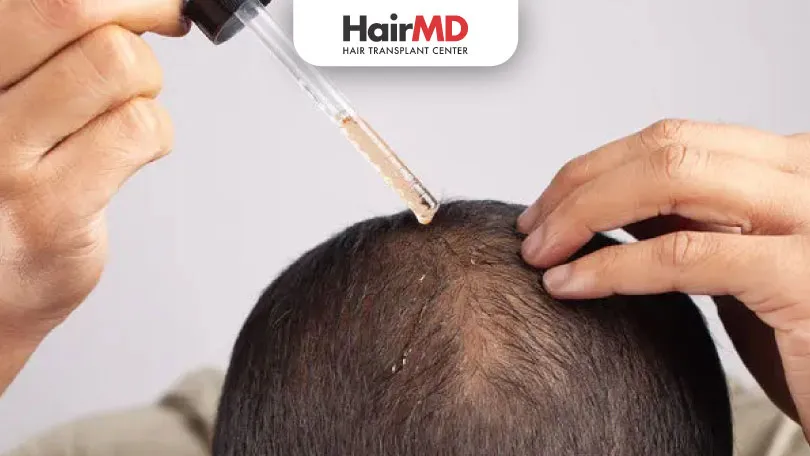 Does Minoxidil Work for Alopecia Areata HairMD Pune