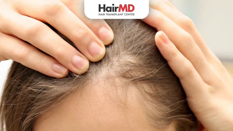 Does Minoxidil Work for Women’s Hair Loss?