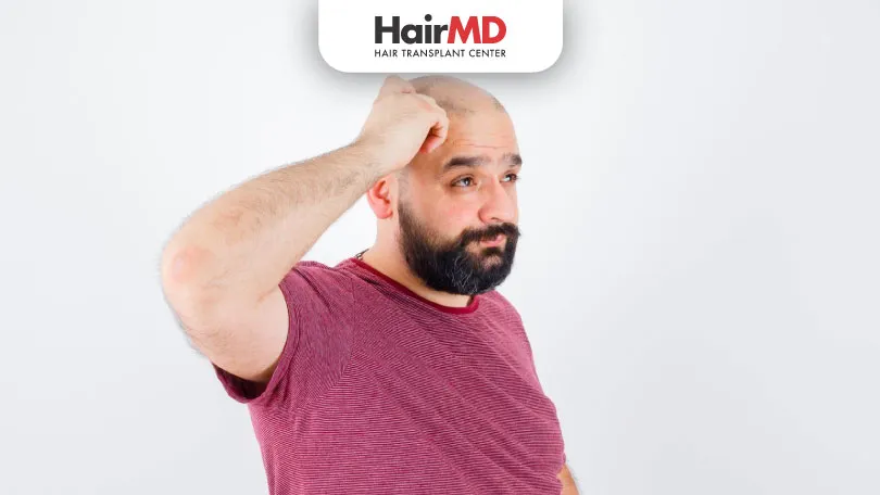 Does Obesity Cause Hair Loss HairMD Pune