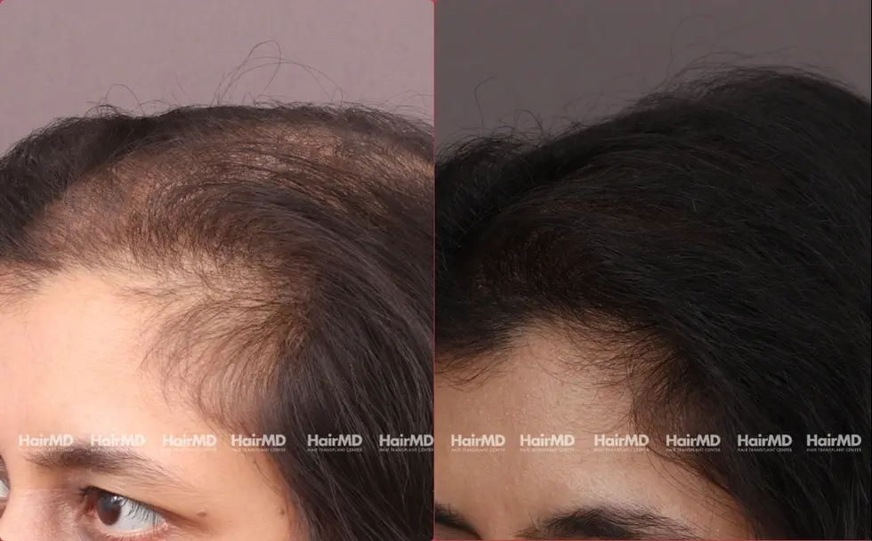 Female Hairloss Results 7 Sessions 6 Months HairMD Pune