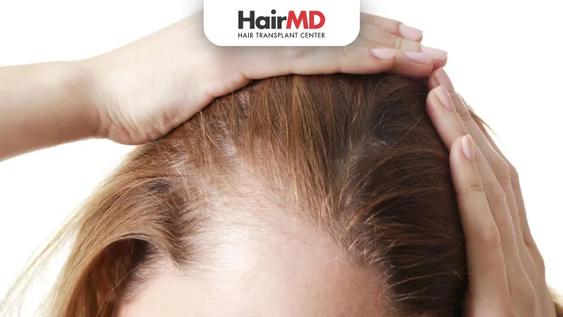 Female Pattern Baldness Causes, Early Signs HairMD Pune