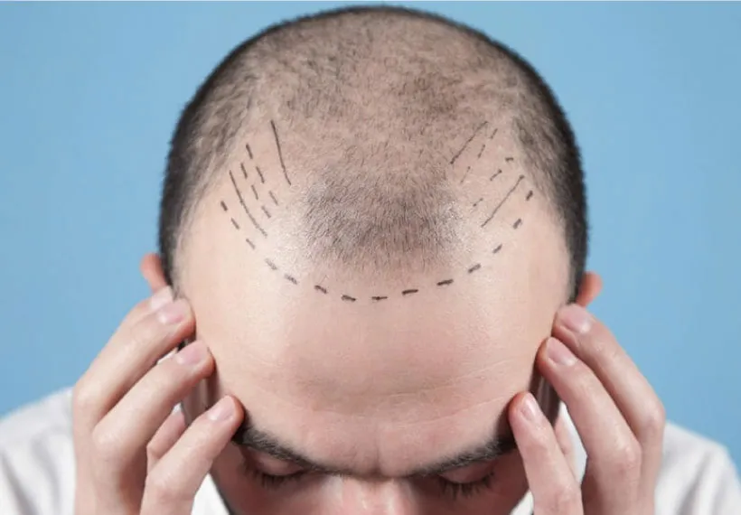 Fue Hair Transplant