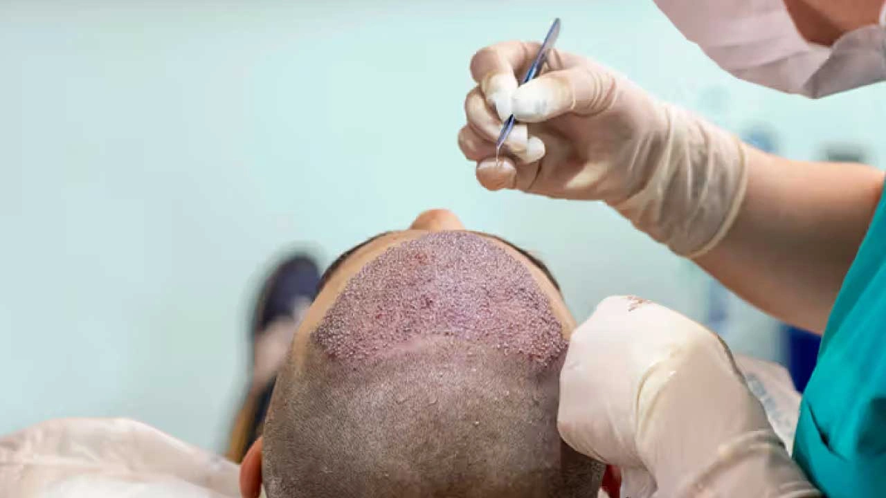 Fue Hair Transplant