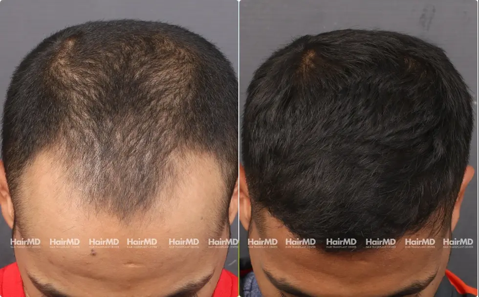 Hairtransplant Results 2 Years 2000-3000 Grafts HairMD Pune