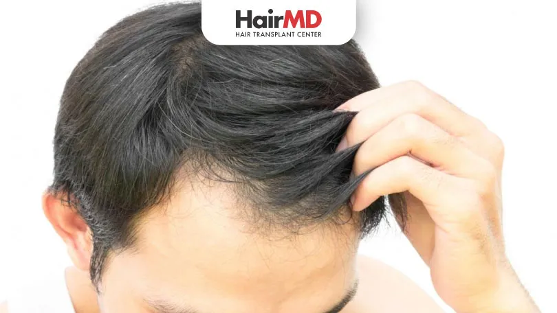 How Long Does It Take to Regrow Hair After Hair Loss?