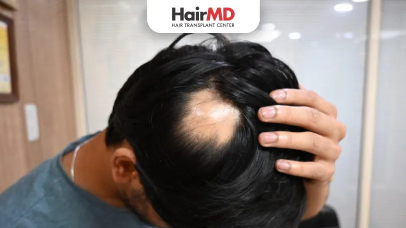 Is Alopecia Areata Curable HairMD Pune