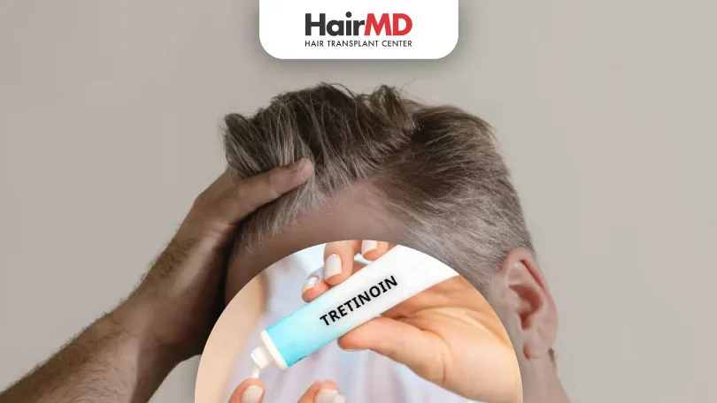 Tretinoin and Hair Restoration: Benefits and Insights