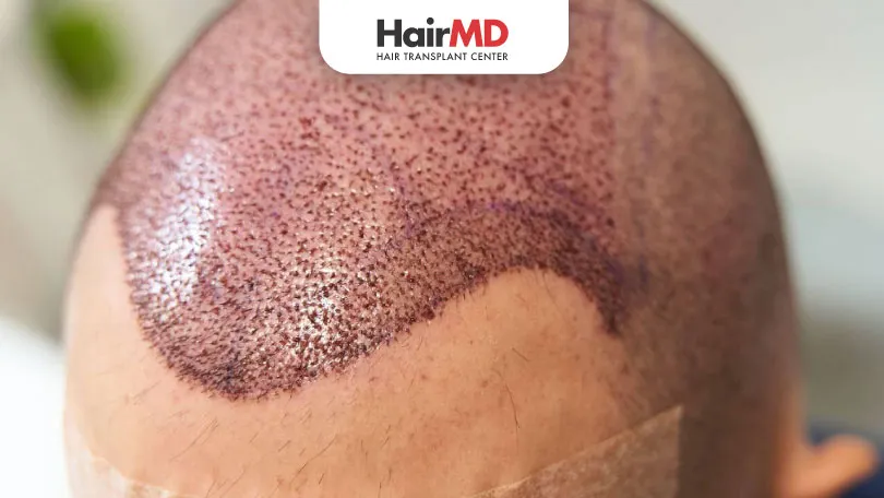 Shedding Phase After Hair Transplant