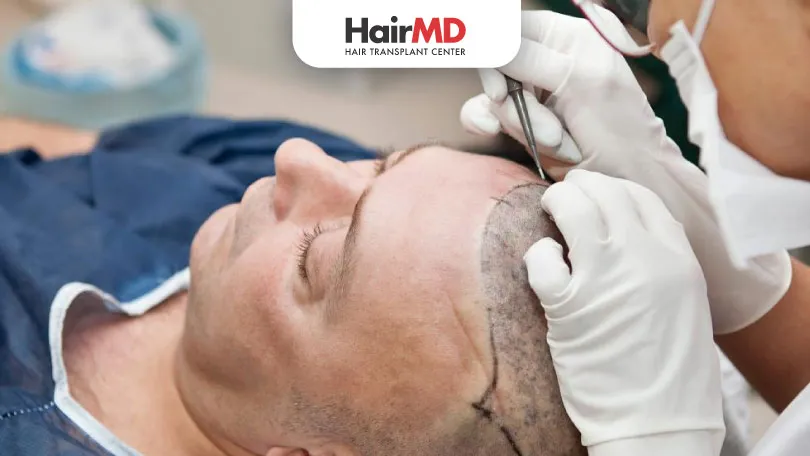 Side Effects of Hair Transplant: Insights from Dermatologist